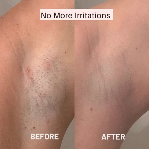 Vrouwen scheermachine – Gladde huid zonder irritatie 